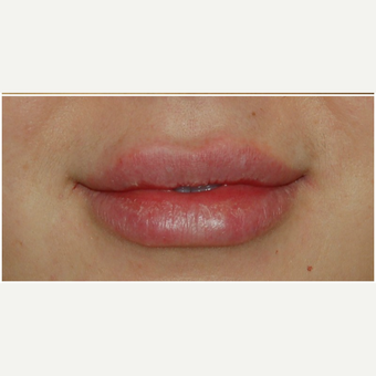 25-34 year old woman treated with Juvederm after 3300586