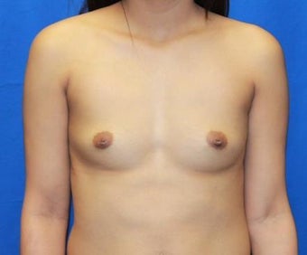 Breast Augmentation before 966278