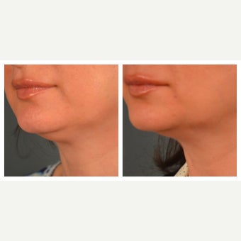 45-54 year old woman treated with Kybella after 2095842
