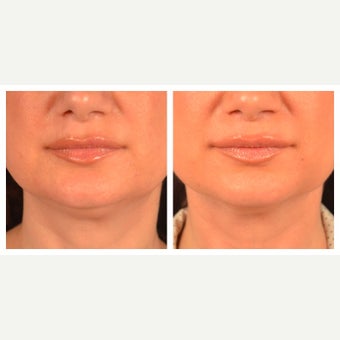 45-54 year old woman treated with Kybella before 2095842