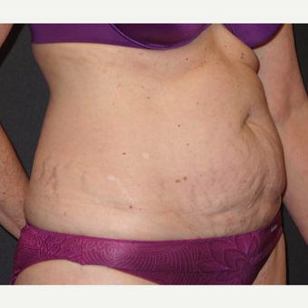 45-54 year old woman treated with Tummy Tuck before 3458175