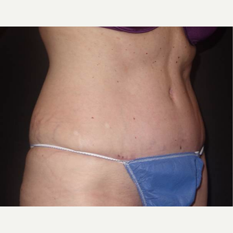 45-54 year old woman treated with Tummy Tuck after 3458175