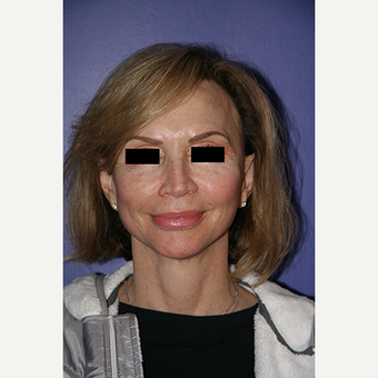 62 year old woman treated with Facelift after 3710684