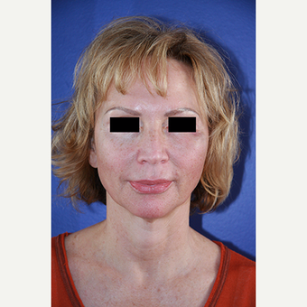 62 year old woman treated with Facelift before 3710684