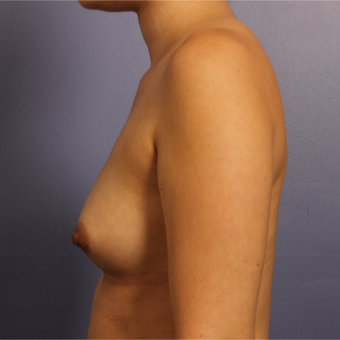 Breast Augmentation before 3657276