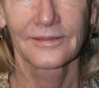 61 Year Old Female treated for wrinkles and spots around mouth before 1260095