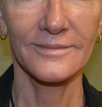 61 Year Old Female treated for wrinkles and spots around mouth after 1260095