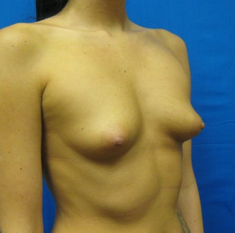 Breast Augmentation, Breast Implants before 1165862