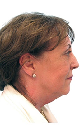 Facelift, Neck lift, Lower Blepharoplasty (eyelid lift), Nd:YAG laser resurfacing 319203