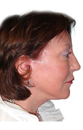 Facelift, Neck lift, Lower Blepharoplasty (eyelid lift), Nd:YAG laser resurfacing 319203