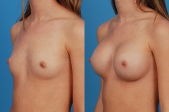 Breast Augmentation: 20-Year-Old Female after 1050797