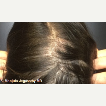 Hair Growth from Platelet-Rich-Plasma Injections before 3774322