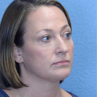 35-44 year old woman treated with Under Eye Enhancement after 3495925