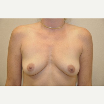 35-44 year old woman treated with Breast Reconstruction before 3104047