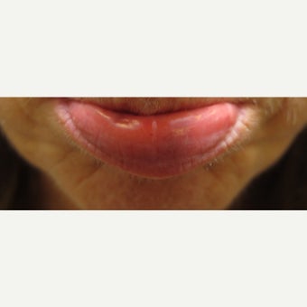 Veinous Lip Lake treated with Cutera Excel V after 1672323