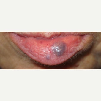 Veinous Lip Lake treated with Cutera Excel V before 1672323