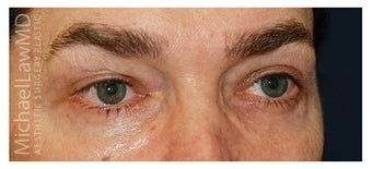 Eye Bag Treatment after 1270399