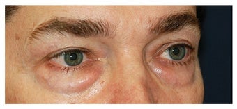 Eye Bag Treatment before 1270399