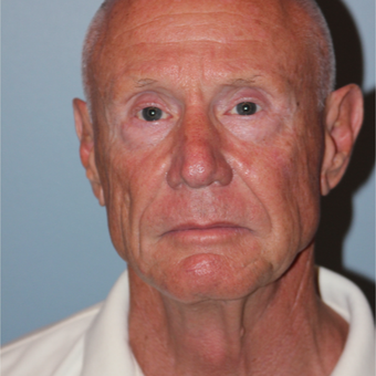 65-74 year old man treated with SMAS Facelift and neck lift before 3465124
