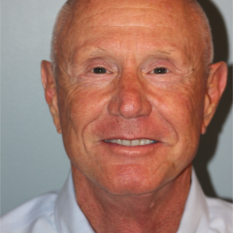 65-74 year old man treated with SMAS Facelift and neck lift after 3465124