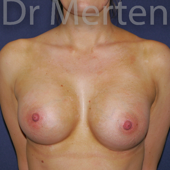 25-34 year old woman treated with Breast Augmentation after 3551678