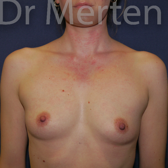 25-34 year old woman treated with Breast Augmentation before 3551678