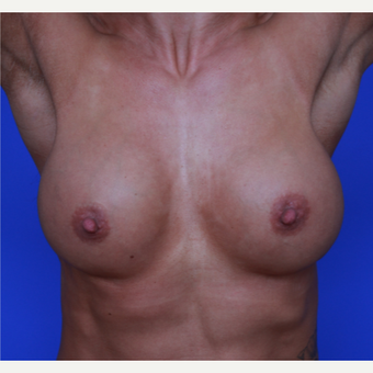 33-year old woman treated with Breast Augmentation before 3652745
