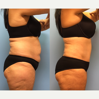 50 year-old woman treated with Tummy Tuck and Lipo 360 before 3495060