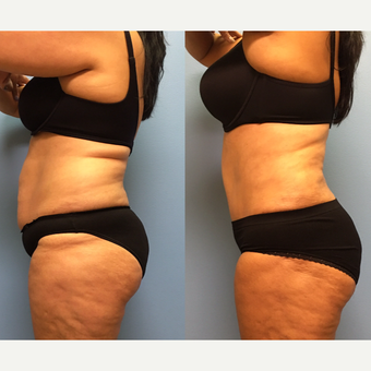 50 year-old woman treated with Tummy Tuck and Lipo 360 after 3495060