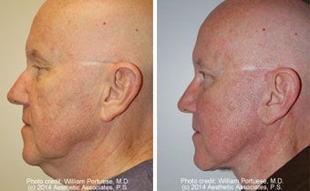 Facelift before 91470