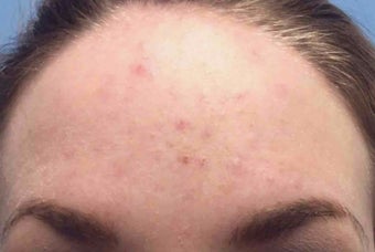 25-34 year old woman treated with Chemical Peel before 3246054