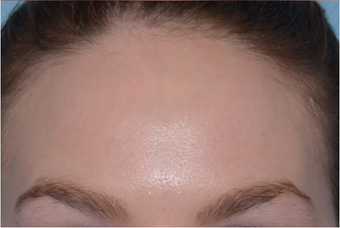 25-34 year old woman treated with Chemical Peel after 3246054