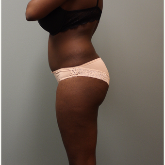 Buttock Augmentation with Implants & Liposuction of the Lower Back before 3852899