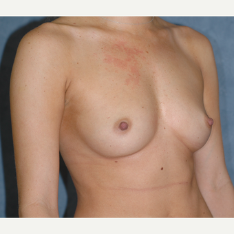 29 Year-Old Breast Augmentation before 3814221