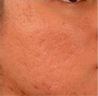 18-24 year old woman treated with Venus Viva after 1961281