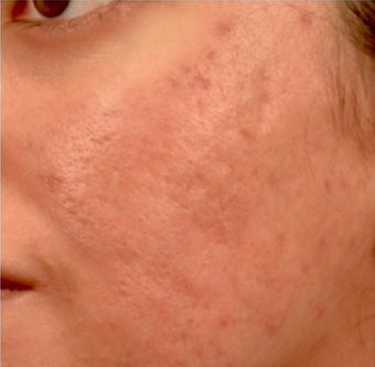 18-24 year old woman treated with Venus Viva 1961281