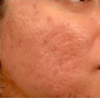 18-24 year old woman treated with Venus Viva before 1961281