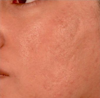 18-24 year old woman treated with Venus Viva 1961281