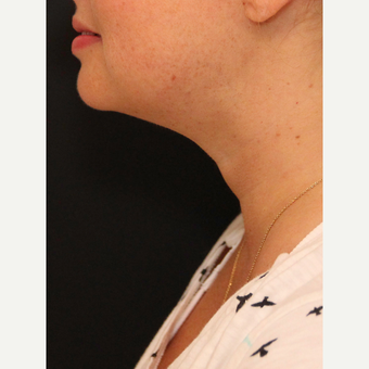 Chin Liposuction after 3617119