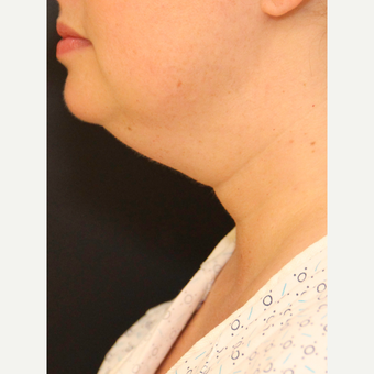 Chin Liposuction before 3617119
