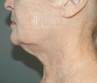 65-74 year old woman treated with Non-Surgical Neck Lift after 3777573
