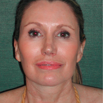 45-54 year old woman treated with Facelift after 3417485