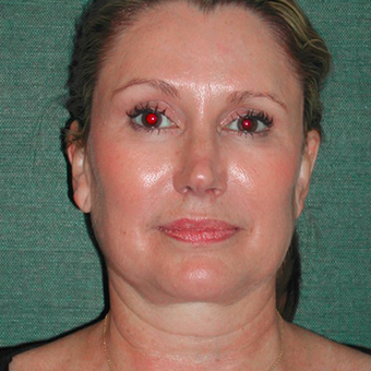 45-54 year old woman treated with Facelift before 3417485