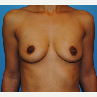 27 year old woman treated with Breast Implants, B to full C cup before 3624410