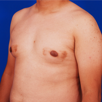 Man Treated with Male Breast Reduction Surgery before 3458628