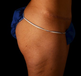 35-44 year old woman treated with Stretch Marks Treatment before 1639784
