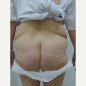 45-54 year old woman treated with Body Lift before 3419928