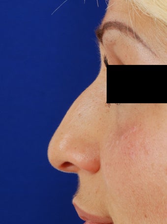20's female for rhinoplasty before 1096758