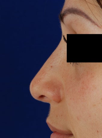 20's female for rhinoplasty after 1096758