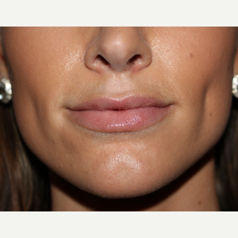 25-34 year old woman treated with Juvederm after 3185366